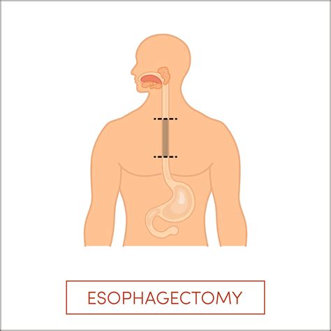 Esophagectomy Open Causes Symptoms Treatment Sexiezpicz Web Porn