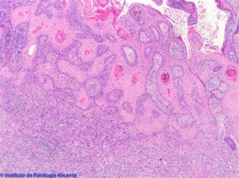 Carcinoma Escamoso Cutáneo Instituto De Patología Alicante