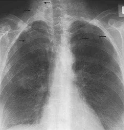 Pulmonary Nodules And Mass Lesions Radiology Key
