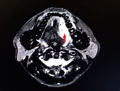 Cureus Tongue Cancer In A Young Male