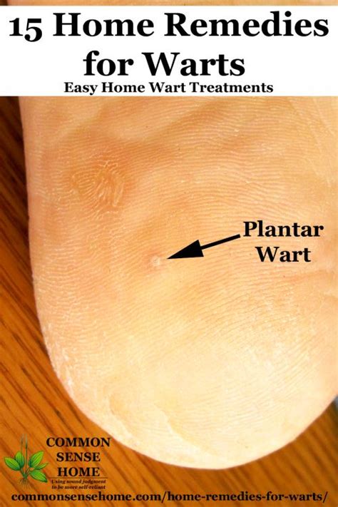 15 Home Remedies For Warts Easy Home Wart Treatments