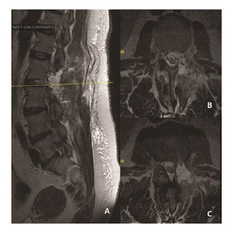 Intraoperative Picture Showing A L2 Nerve Root B Dural Sac C L3