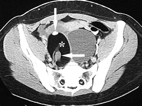 Ct And Mri Of Adnexal Masses In Patients With Primary Nonovarian