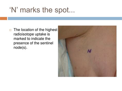 Ppt Sentinel Lymph Node Biopsy In Melanoma Powerpoint Presentation