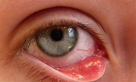 How To Get Rid Of A Stye Overnight
