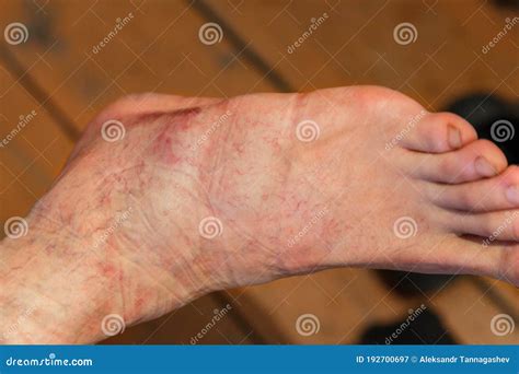 Swollen Injured Male Limb On The Left Foot With Hematoma When A Heavy