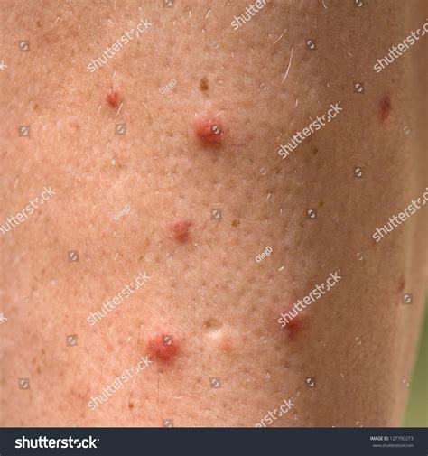 Allergic Rash Dermatitis Leg Skin Patient Stock Photo 127790273