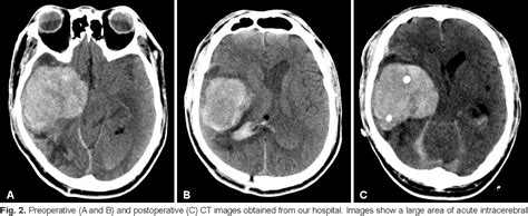Figure 2 From A Case Of Intracranial Solitary Fibrous Tumor