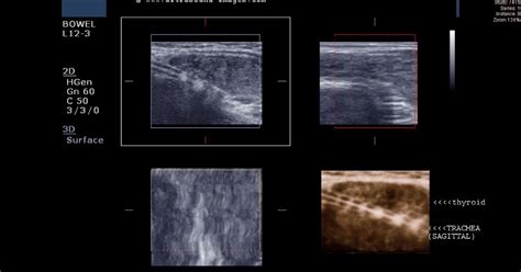 Ultrasound Imaging Thyroid Goiter 2d And 3d Images