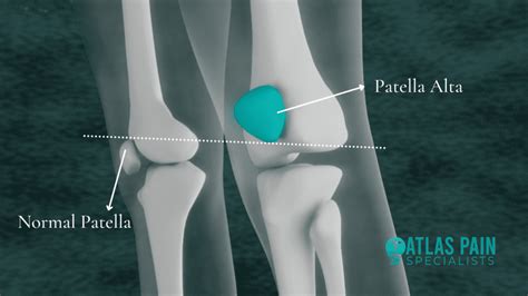 Possible Causes And Treatment Of Patella Alta Atlas Pain Specialists