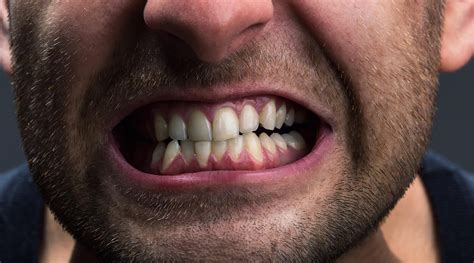 Protect Your Teeth From Grinding Bruxism • Ascent Dental Care