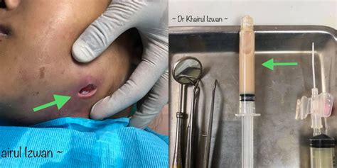 Kebersihan gigi yang baik dapat mencegah munculnya gigi berlubang. "Karang Gigi, Sisa Makanan Penuh Dalam Mulut," Doktor ...