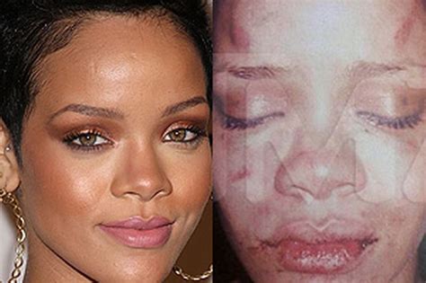 Rihanna S Battered Face Leaked Picture Shows Injuries After Alleged Assault By Chris Brown