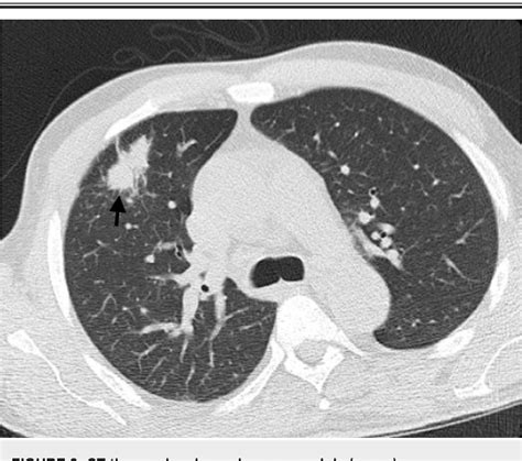 Figure 2 From Disseminated Nocardiosis In A Renal Transplant Recipient