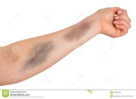 Large Bruise On Human Arm Stock Image Image Of Painful 104226973
