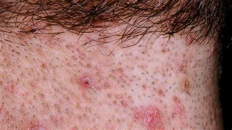 Ingrown Hair Pics 🍓folliculitis Causes Signs Symptoms How To Get