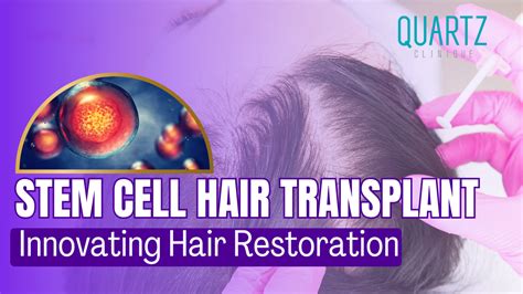 Stem Cell Hair Transplant Innovating Hair Restoration 2023