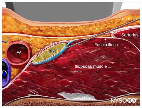 Ultrasound Guided Femoral Nerve Block Nysora Nysora