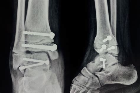 Paediatric Salter Harris Type Iv Injury Of Distal Tibia With Talus