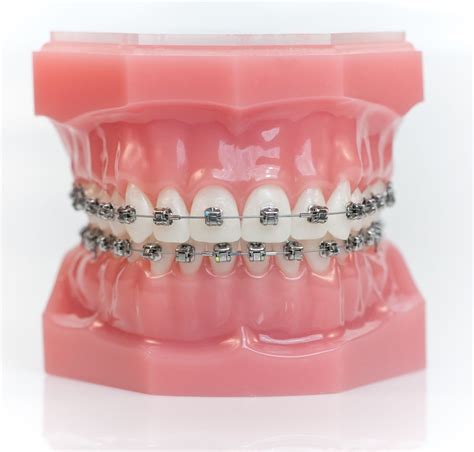 The Benefits Of Damon Clear And Metal Braces Alborzi Orthodontics