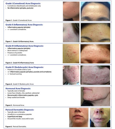 A Physicians Guide To Treating Acne