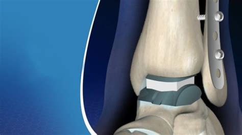 Ankle Replacement Surgery Procedure Post Measures And Projections