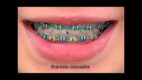 Brackets Imagenes Youtube