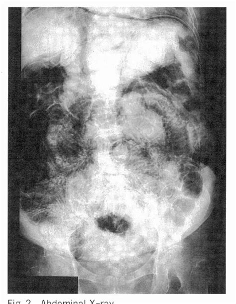 Figure 3 From A Case Of Pneumatosis Cystoides Intestinalis With