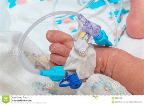 Peripheral Intravenous Catheter In The Vein Of Newborn