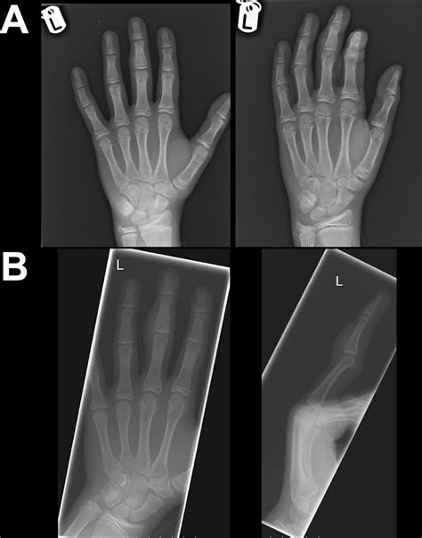 Recurrent Calcifying Aponeurotic Fibroma Of The Hand Managing A Rare