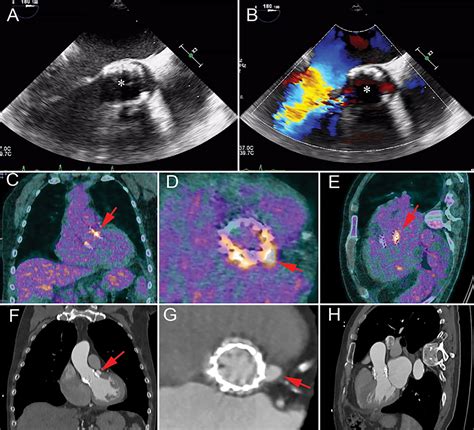 Role Of Cardiac Ct In Infective Endocarditis Current Evidence