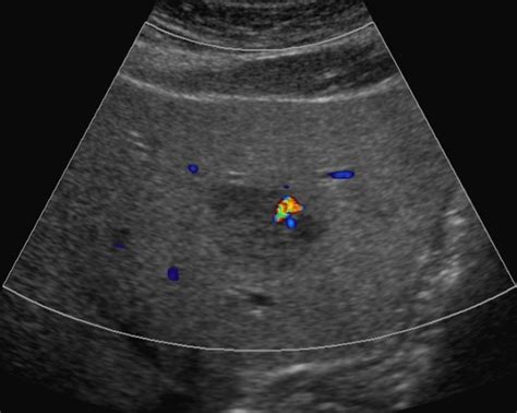 Focal Nodular Hyperplasia Liver Ultrasound