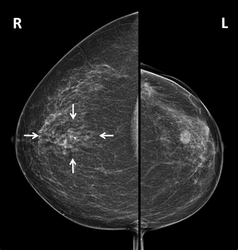 A Rare Case Of A Benign Breast Lesion Eurorad