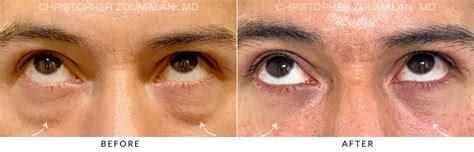 Male Blepharoplasty Before And After Photo Gallery
