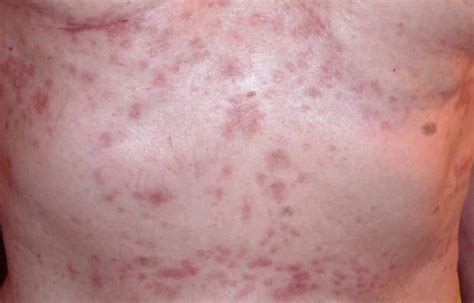 Papular Eczema Symptoms Causes And Treatment Artofit