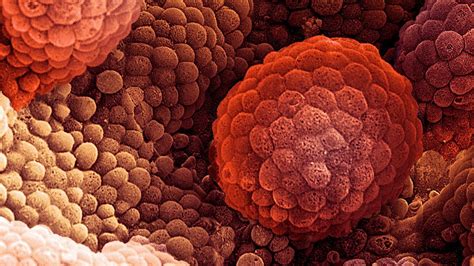 Discerning whether the patient has widely advanced disease versus locally advanced disease (clinical stage t3) assists in determining what treatment options are. Breast cancer drug may help men with prostate cancer ...