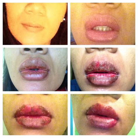 A Friend Of Mine Had An Allergic Reaction To Lip Balm Heres Photos Of