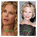 Meg Ryan Plastic Surgery Photos [Before & After] - Surgery4