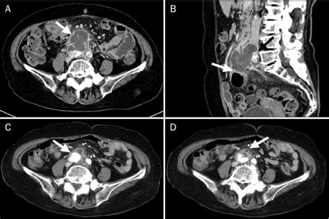 Contrast Enhanced Ct Scans A Low Density Lesion Measuring