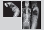 Specialized expertise for spinal deformity surgery - Mayo Clinic