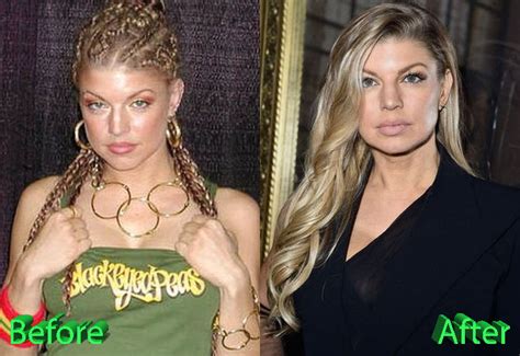 Fergie Plastic Surgery Before and After Review