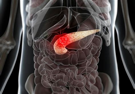 Best Practices To Screen For Pancreatic Cancer In High Risk Individuals