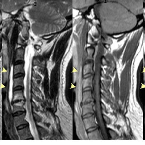 Preoperative Cervical Spine Magnetic Resonance Sagittal Imaging Showing