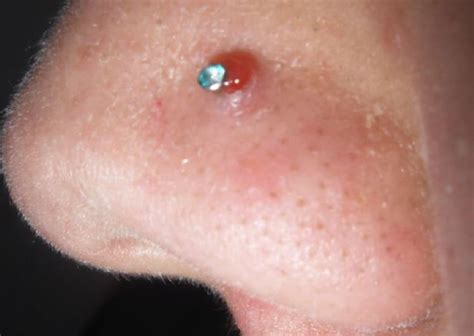 Lump In Nose Pimple Wont Go Away Painful Red Swollen Get Rid