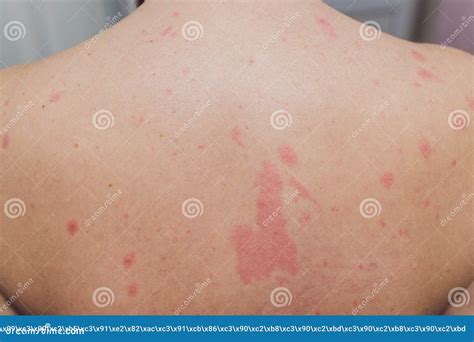 Close Up Allergy Rash Around Back View Of Human With Dermatitis