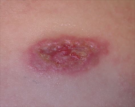 Localized Cutaneous Sporotrichosis In A Child Dermatology Jama