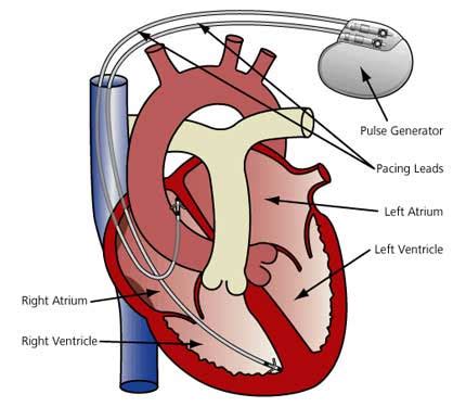 Through these two medical devices, the pacemaker and the icd, heart problems can now be easily controlled. Pacemaker/ICD Implantation Procedure Cape Town