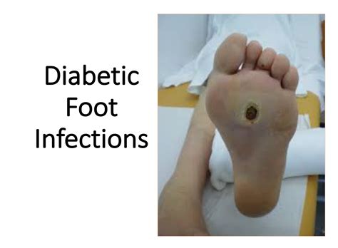The Diabetic Foot Infection When And What Types Of Antibiotics Are