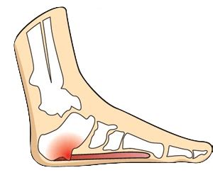 Update Minimally Invasive Heel Spur Surgery Best Esthdonghoadian