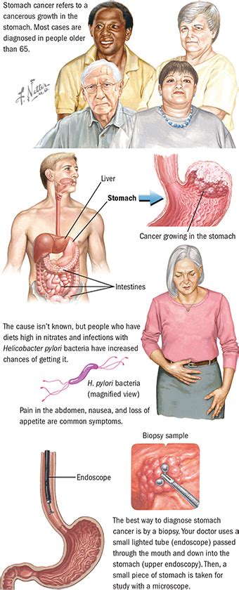 A procedure that makes a series of detailed pictures of areas inside the body, taken. Stomach Cancer | Upper GI Cancers | Spectrum Health